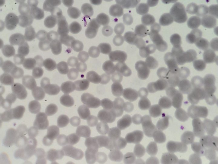 Blood smear: Trypanosoma cruzi trypomastigote next to a neutrophil