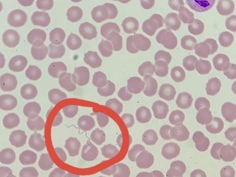 Мазок крови: спирохета Borrelia в поле зрения среди эритроцитов