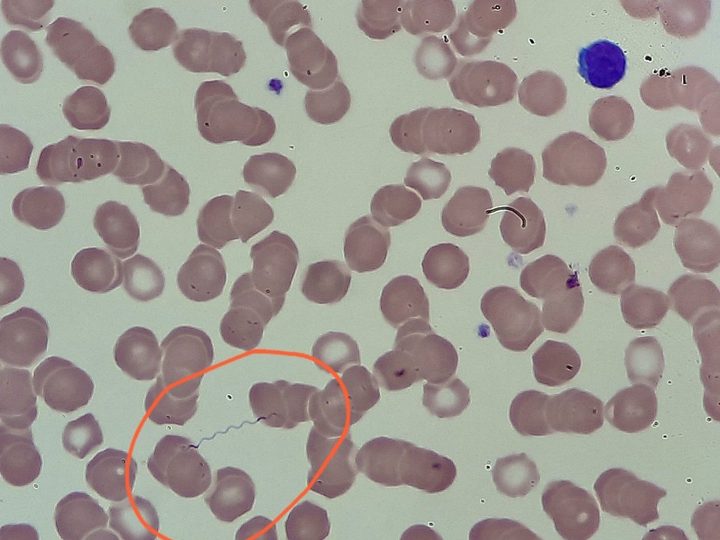 Мазок крови: спирохета Borrelia в круге и лимфоцит в верхнем правом углу