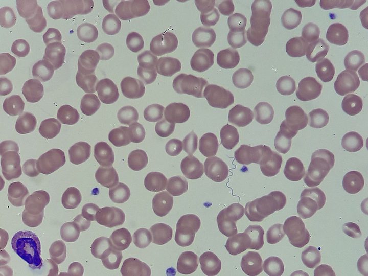 Мазок крови: спирохета Borrelia между эритроцитами и моноцит в углу поля