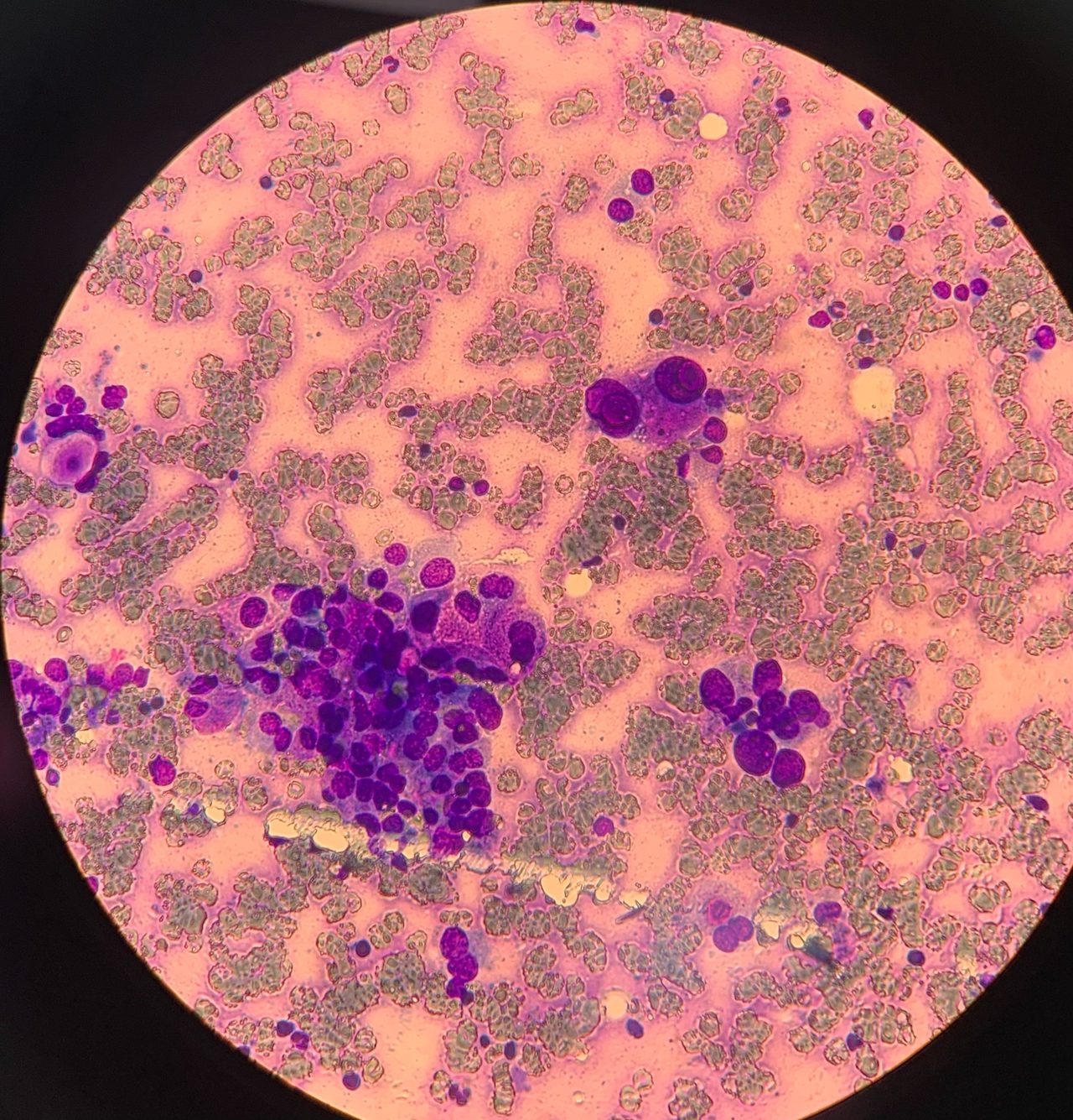Cytological Features of Medullary Thyroid Carcinoma