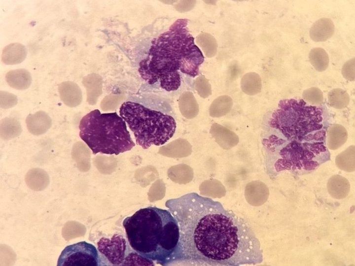 Мазок костного мозга: плазмоциты с вакуолизацией цитоплазмы