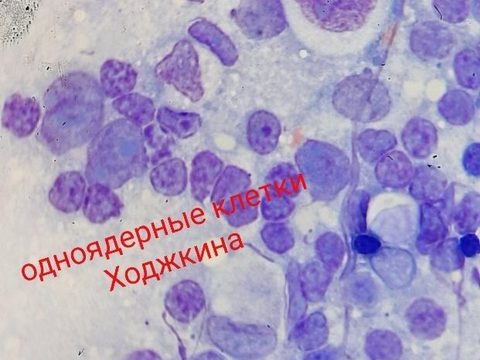 Мазок-отпечаток: одноядерные клетки Ходжкина с перинуклеарным просветлением