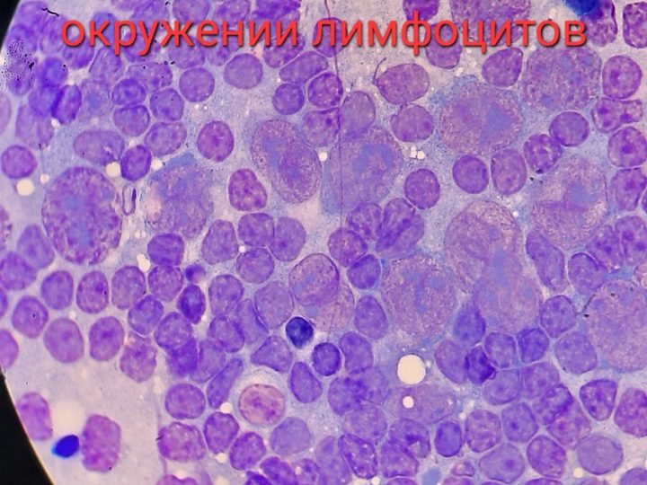 Мазок-отпечаток биоптата: скопления клеток Ходжкина в окружении лимфоцитов