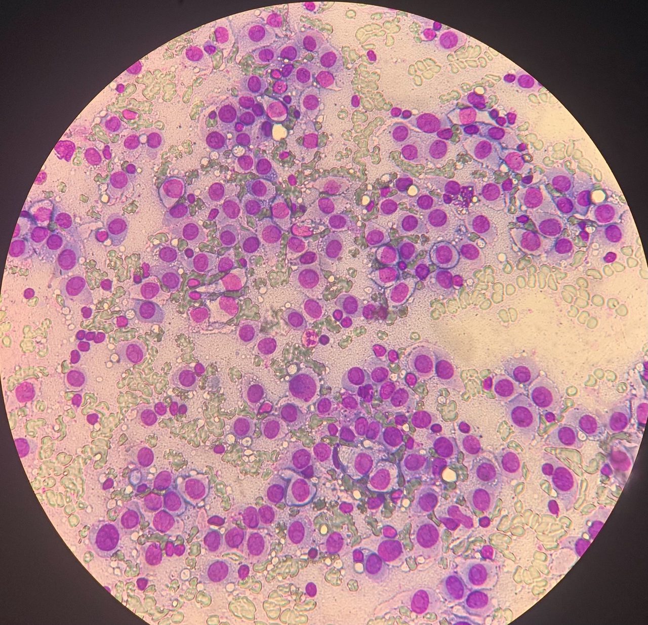 Melanoma Metastasis to Lymph Node: Cytology