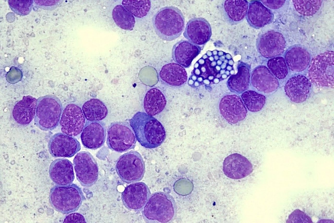Cytology of Nodal Marginal Zone Lymphoma with Mott Cells