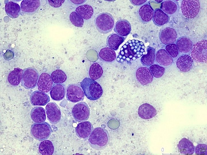 Cytological preparation of a lymph node: Mott cell among lymphoid elements