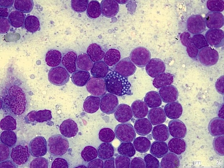 Cytological smear: Mott cell in the center of a monomorphic lymphoid infiltrate