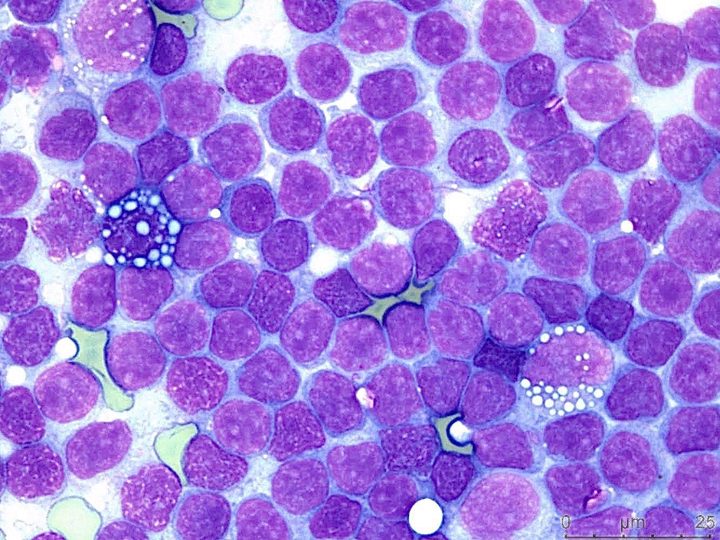 Cytological preparation: lymphoid cells and two Mott cells with Russell bodies