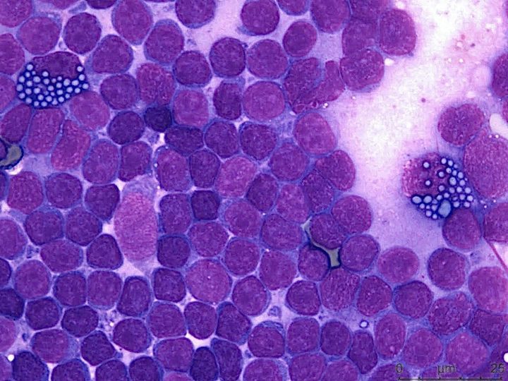 Cytological smear of a lymph node: pleomorphic lymphoid cells and Mott cells