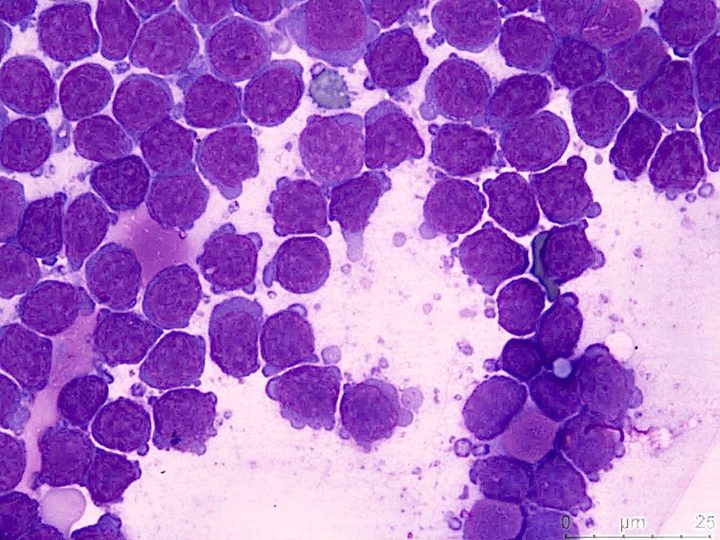 Cytological preparation: monomorphic population of neoplastic lymphoid cells