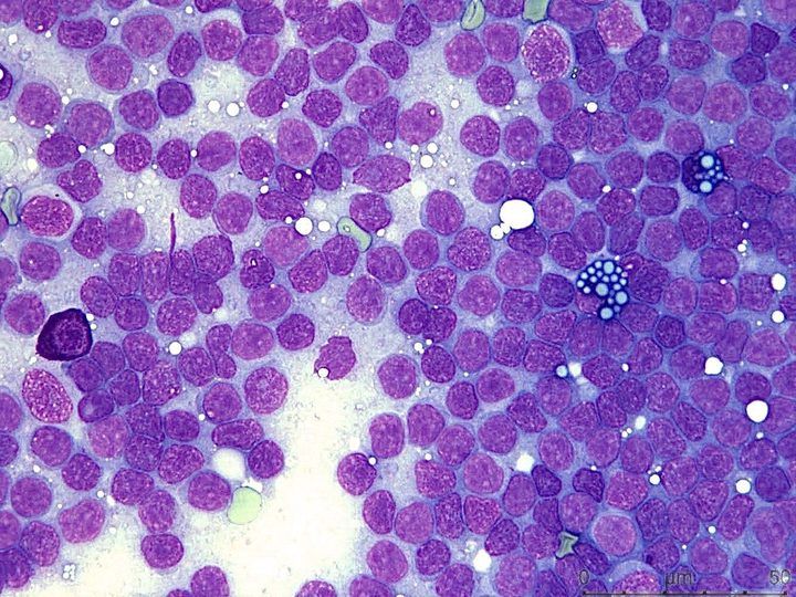 Cytological smear of a lymph node: diffuse infiltration and scattered Mott cells