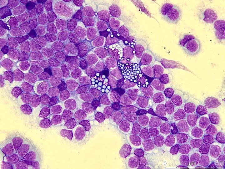 Cytological preparation: cluster of Mott plasma cells with inclusions