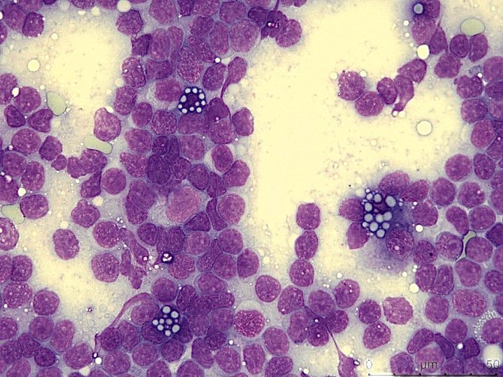 Cytological smear: multiple Mott cells among small lymphoid cells