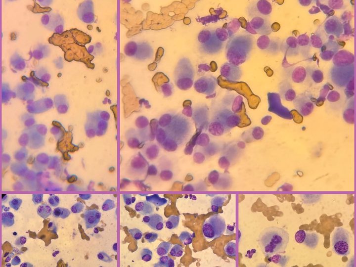Impression smear of the neoplasm: polymorphic atypical plasma cells