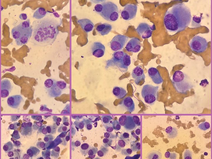 Impression smear of the tumor: atypical plasma cells, anisokaryosis, and a mitotic figure