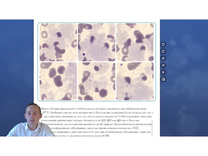 Presentation slide with blood smears in cryoglobulinemia and description