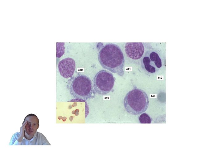 Bone marrow smear with myeloid cells and a cytochemical insert
