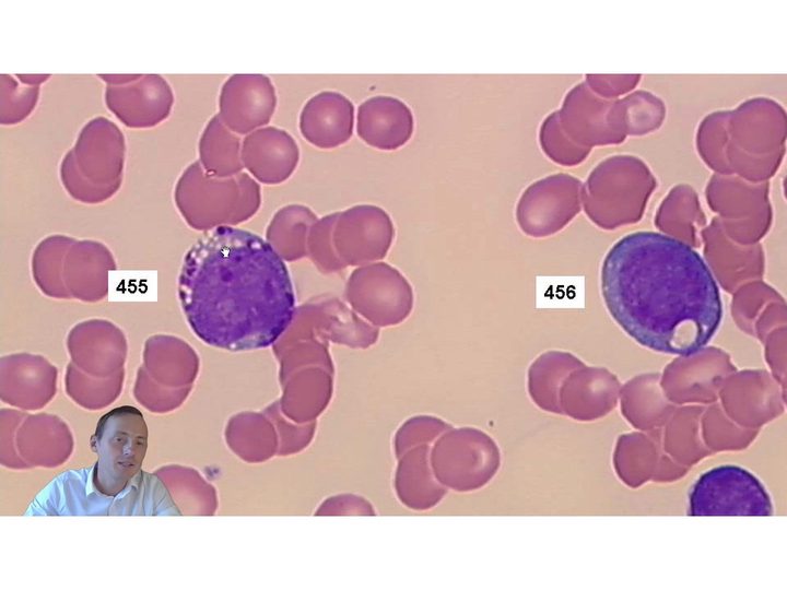 Peripheral blood smear with atypical mononuclear cells in the field of view