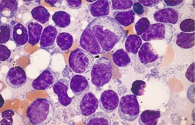 Cytoplasmic Inclusions in Neoplastic Lymphocytes