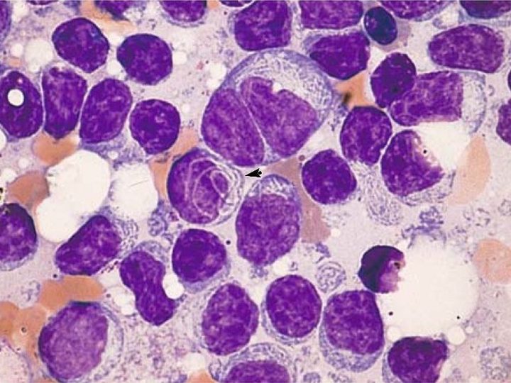 Bone marrow smear: filamentous inclusion in the cell cytoplasm, indicated by an arrow