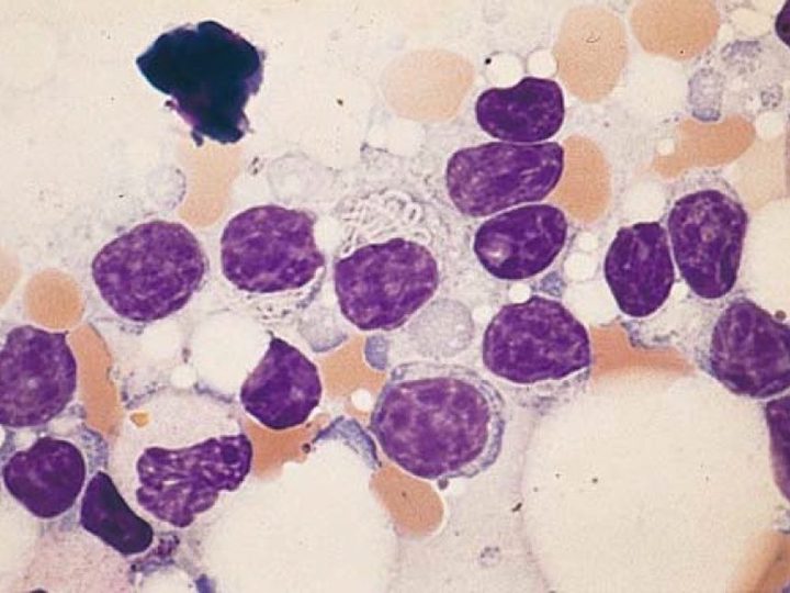 Bone marrow smear: globular inclusion in the cytoplasm of a neoplastic lymphocyte