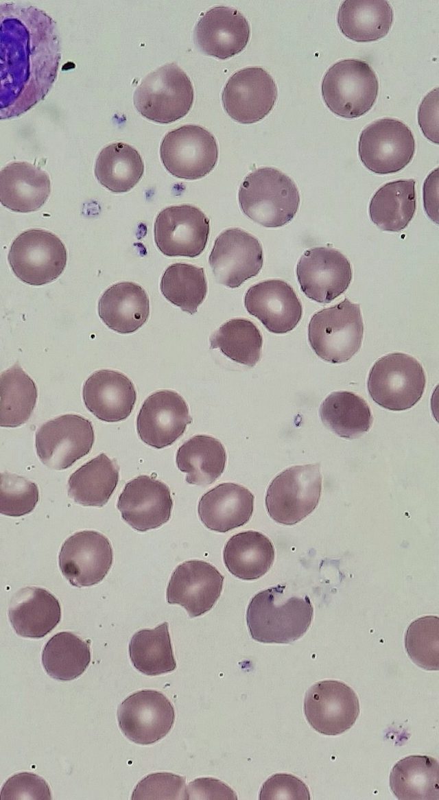 Дефицит Г-6-ФДГ: дегмациты в мазке крови при гемолизе