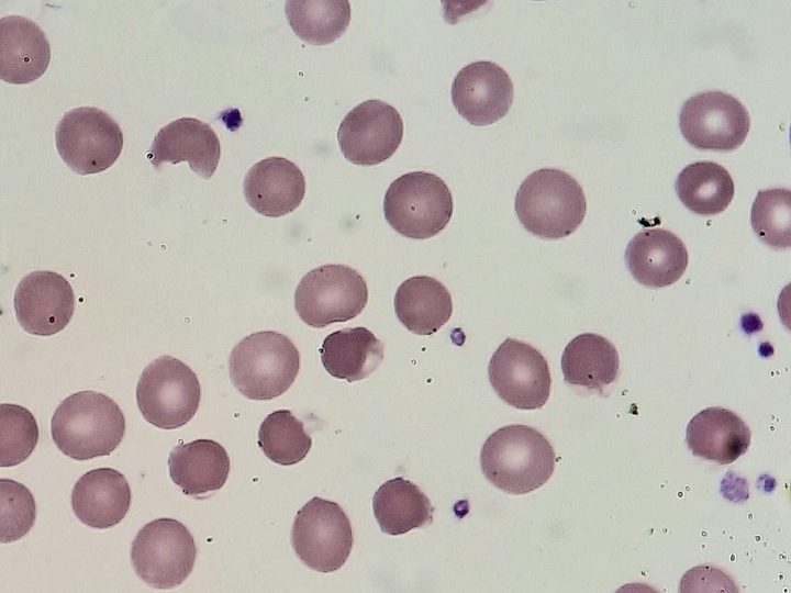 Мазок крови: выраженный пойкилоцитоз с наличием типичных дегмацитов (bite cells)