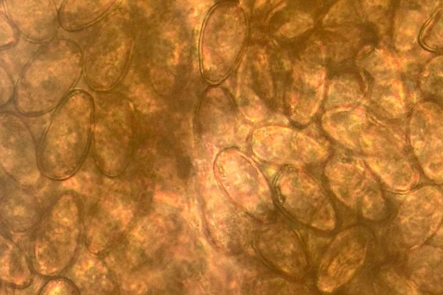 Opisthorchiasis Diagnosis via Duodenal Intubation
