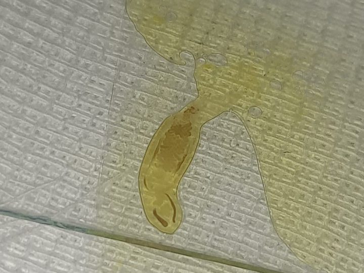 Preparation on a microscope slide: adult fluke from duodenal fluid
