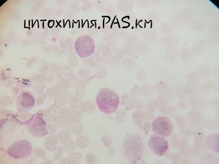 Мазок костного мозга, диффузно-гранулярная PAS-реакция в лейкозных клетках