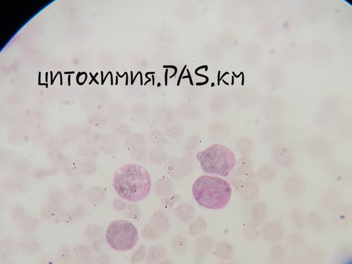 Мазок костного мозга, гранулярная PAS-позитивность атипичных клеток