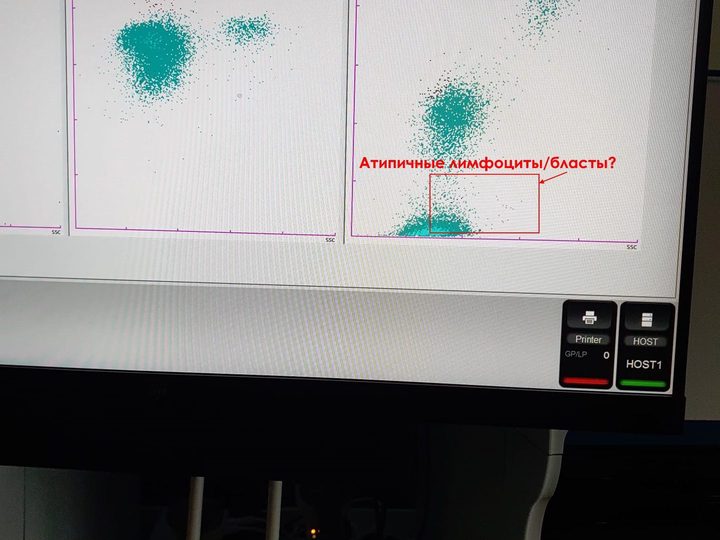 Скатерограмма канала WPC анализатора Sysmex с зоной атипичных лимфоцитов и бластов