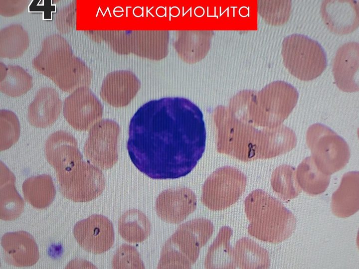 Мазок крови: оголенный фрагмент ядра мегакариоцита с гиперхромной структурой