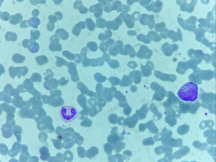 Blood smear: neutrophil and a large cell with pronounced dark cytoplasmic granularity