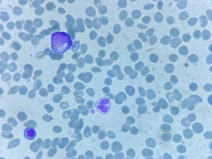 Blood smear: cell with abundant cytoplasmic granularity, neutrophil, and lymphocyte