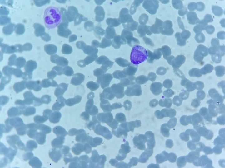 Blood smear: rounded cell with dense granularity and a segmented neutrophil