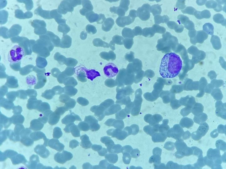 Blood smear: granulated cell in the field of view with several neutrophils