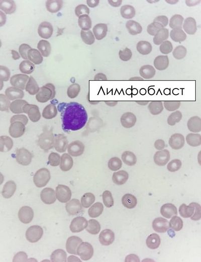 Дифференциальная диагностика Т-лимфобластов и Т-пролимфоцитов