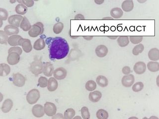 Мазок костного мозга, лимфобласт с выпячиваниями цитоплазмы при Т-ОЛЛ