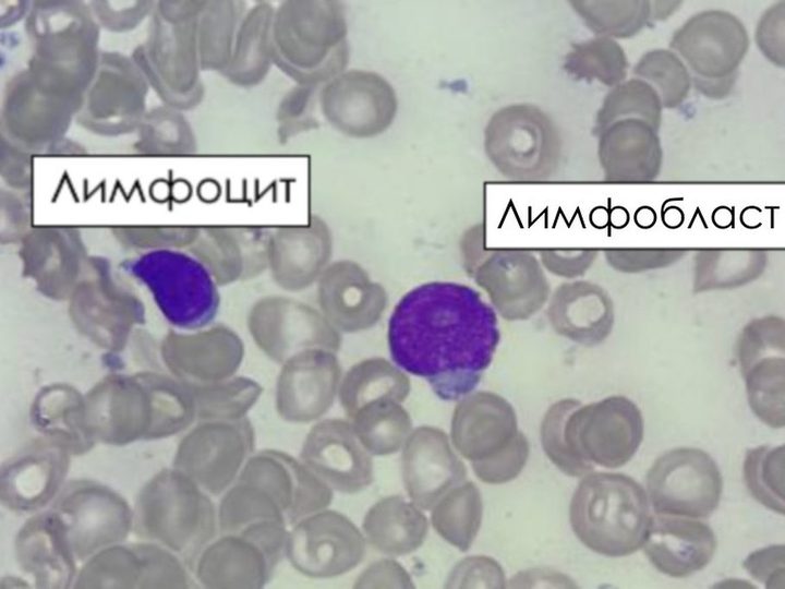 Мазок костного мозга, сравнение зрелого лимфоцита и лимфобласта