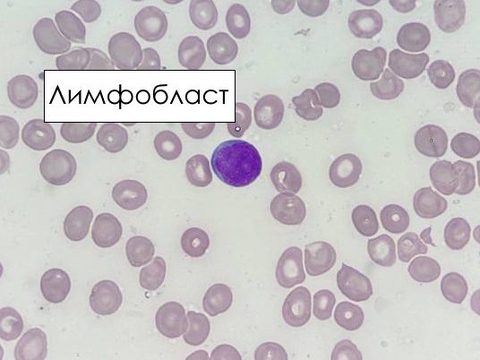 Мазок костного мозга, лимфобласт с мелкодисперсным хроматином