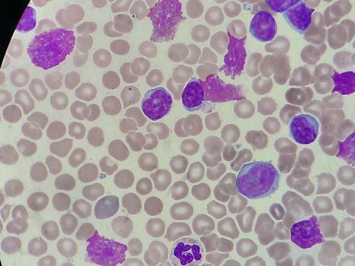 Мазок периферической крови: разрушенные лимфоидные клетки в препарате