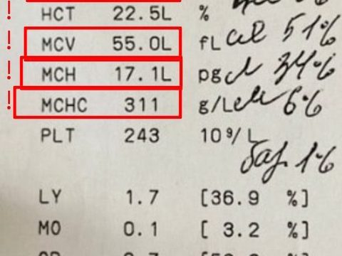 Analyzer printout: microcytic anemia with HGB 70 g/L and MCV 55.0 fL