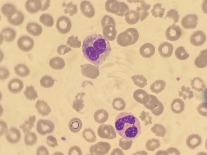 Blood smear: hyposegmented neutrophil with pince-nez shaped nucleus
