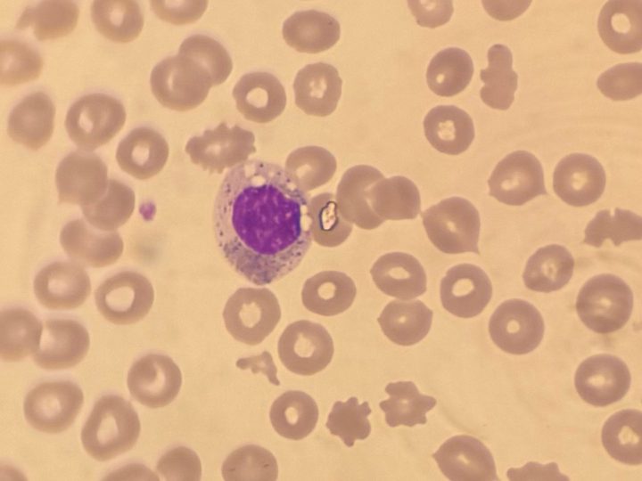 Peripheral blood smear: hypogranulated neutrophil with a round nucleus