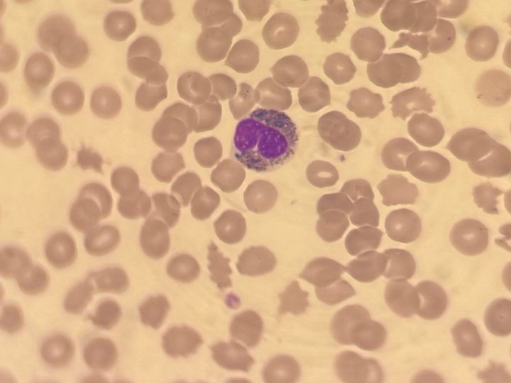 Blood smear: bilobed neutrophil with dysplastic granulation