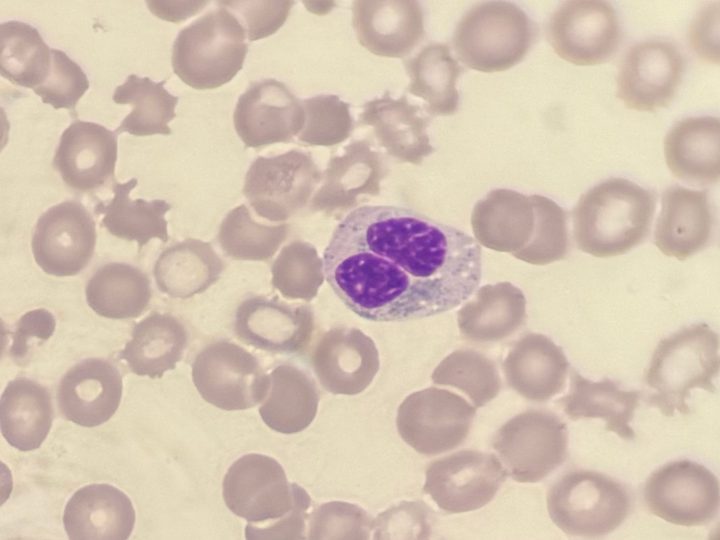 Peripheral blood smear: neutrophil nuclear hyposegmentation in MDS