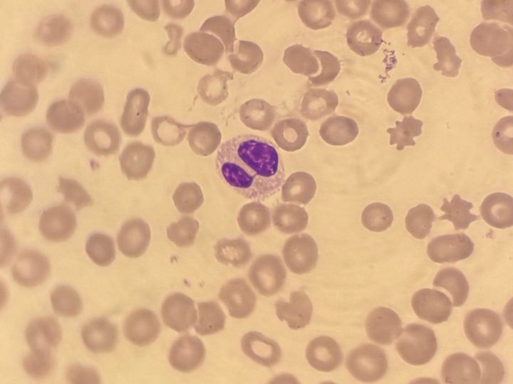 Blood smear: pseudo-Pelger neutrophil and erythrocyte poikilocytosis
