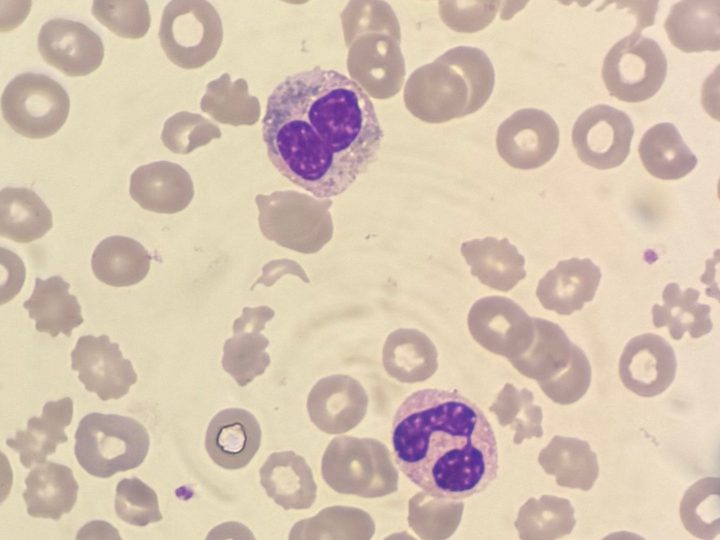 Peripheral blood smear: dysgranulocytopoiesis and acanthocytes in the field of view